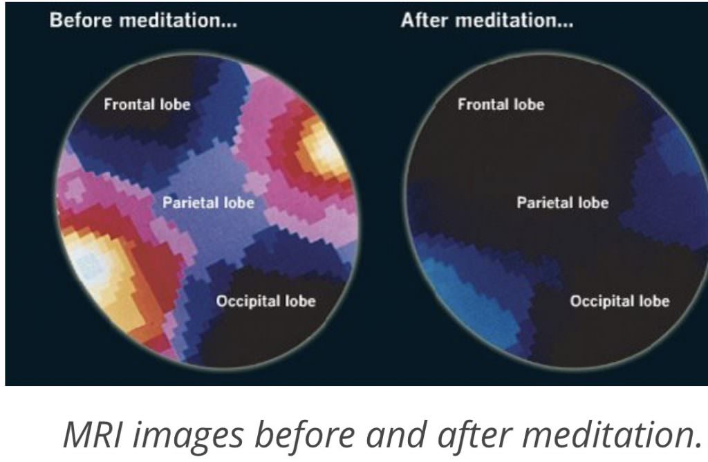 MRI brain changes after meditation